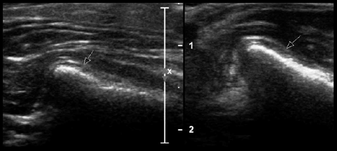 The value of ultrasound for ruling in or out disc displacement in the ...