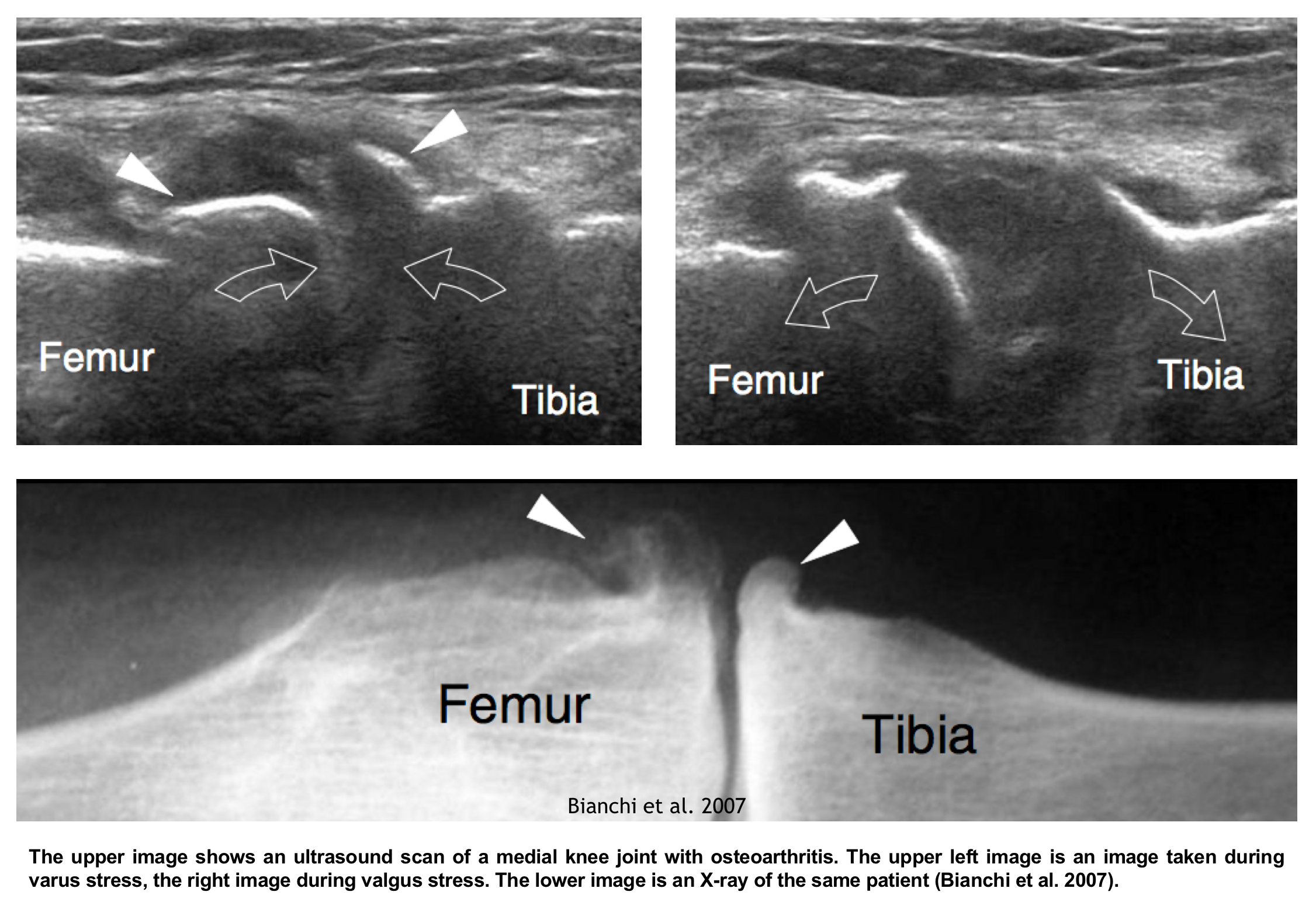 Ultrasound in knee osteoarthritis: the added value